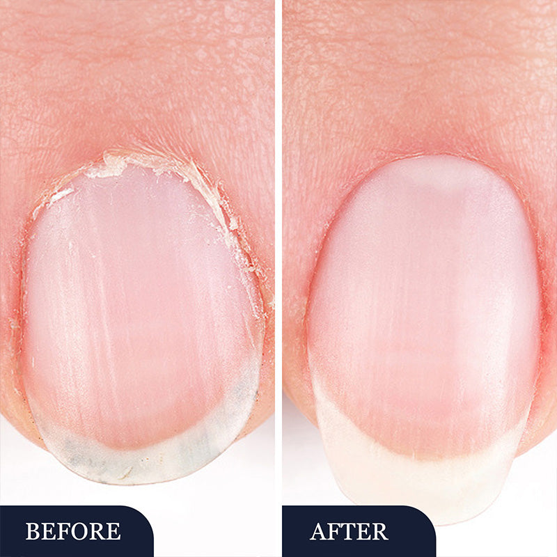 🔥Nagų grybelio gydymo pieštukas (pažeistiems nagams)-LT